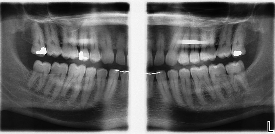 Extraoral Bitewings