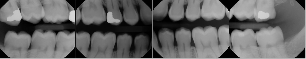 Intraoral Bitewings